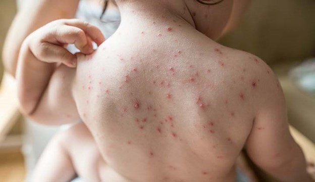 This is an image of a rash from measles. Measles is on of the world’s most contagious diseases. The incidents of measles are up across the country, with zero diagnoses at West Po this year. We have seen other traditionally vaccine preventable diseases here this year: Whooping Cough and    Chickenpox. 
   PHOTO: Cleveland Clinic 